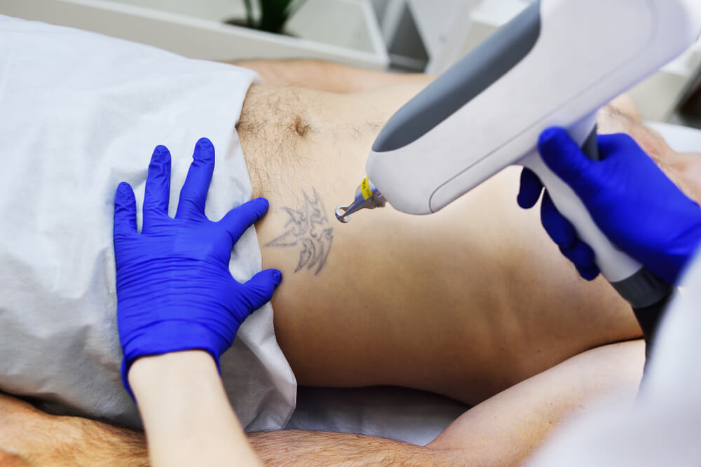 Tattoo Removal