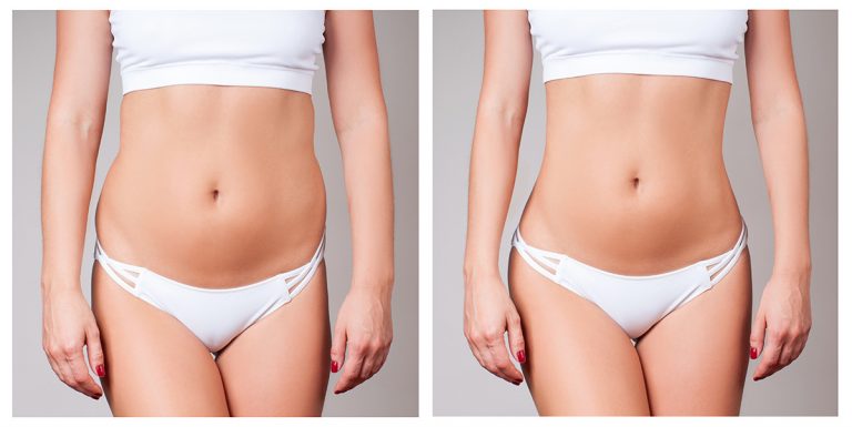 Ultimate Fat Reduction Package at Pure Beauty Lounge, Hampton TW12