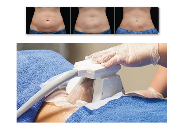 Cryolipolysis (Fat Freezing)